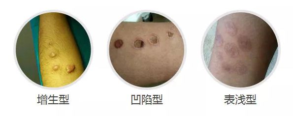 “另类刺青”—— 烟疤，如何祛除？_李辰杰_住院医师_爱问健康