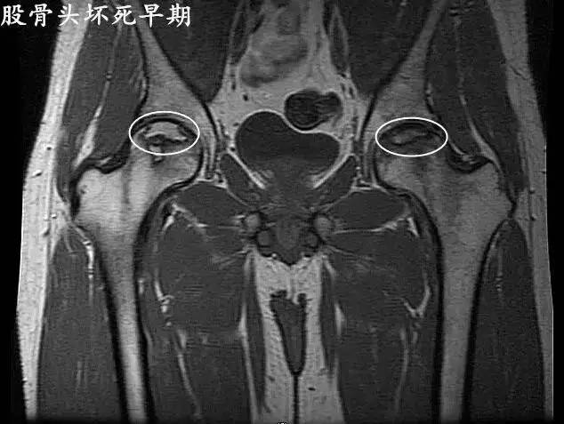 股骨头坏死双线征图片图片