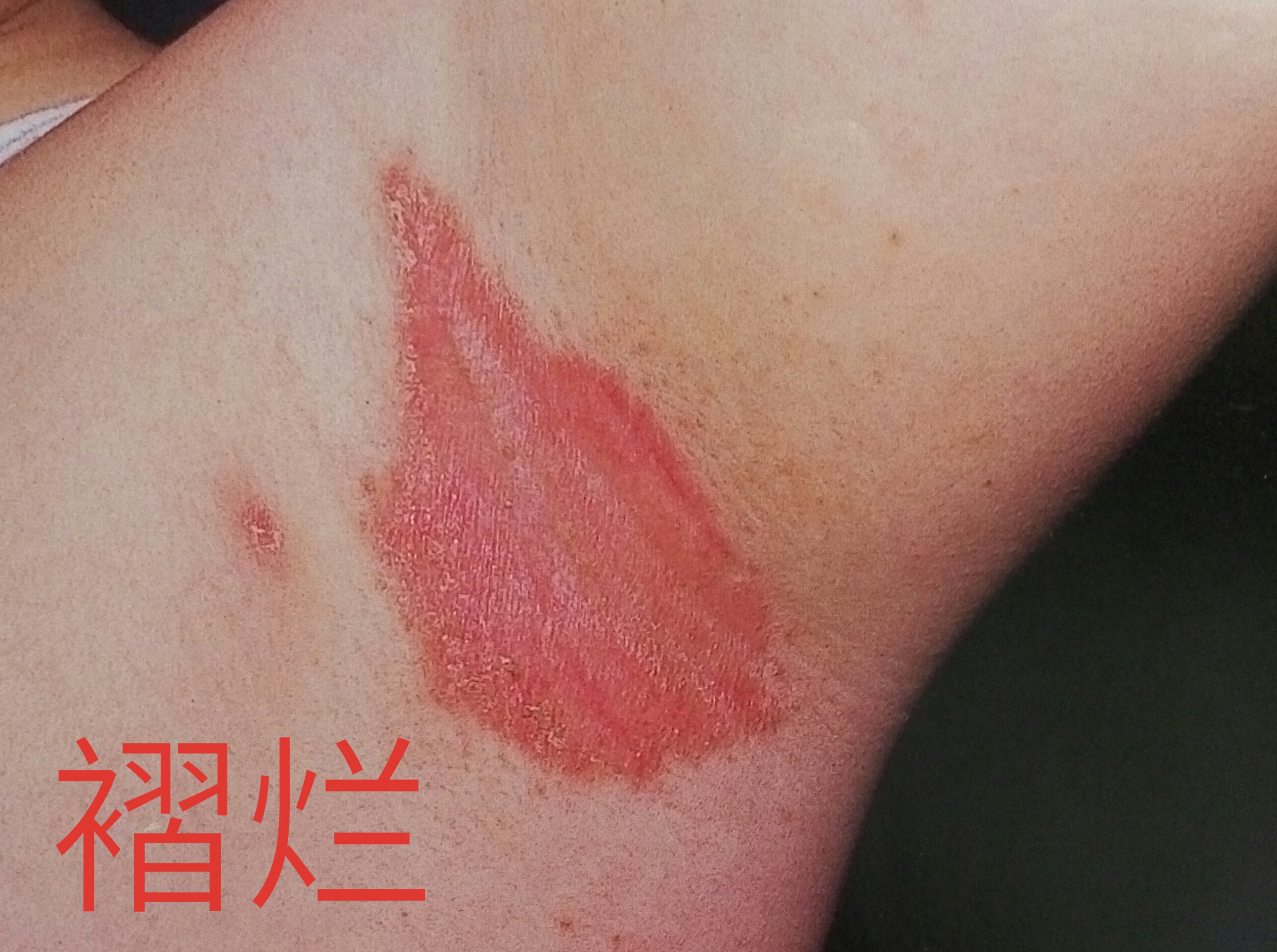 宝宝夏季皮肤保卫战