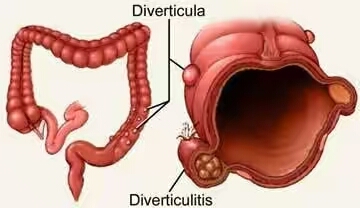 事实上,阑尾炎盲肠憩室鉴别非常困难,为什么说阑尾炎,盲肠憩室鉴别