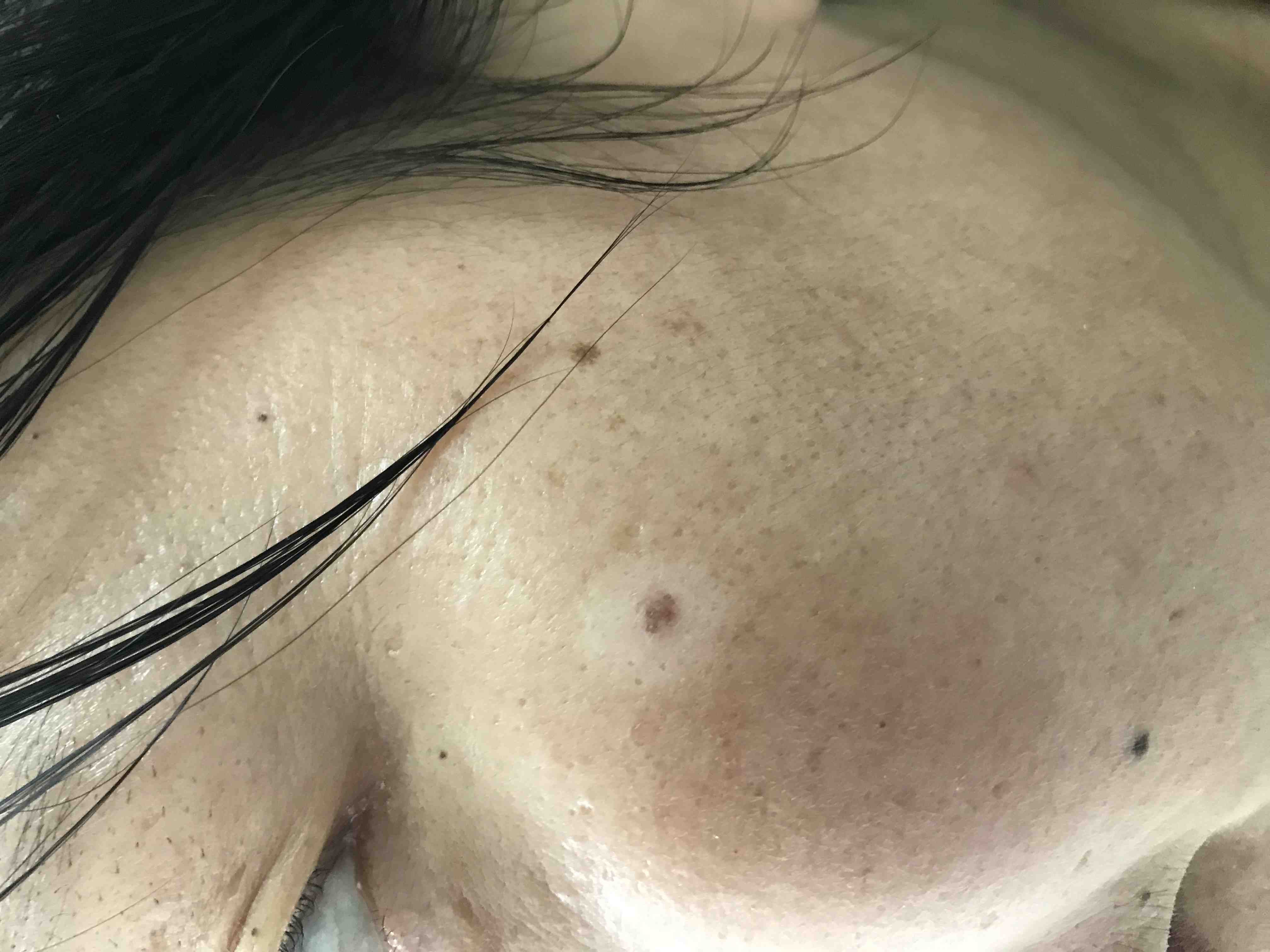 晕痣的姑娘