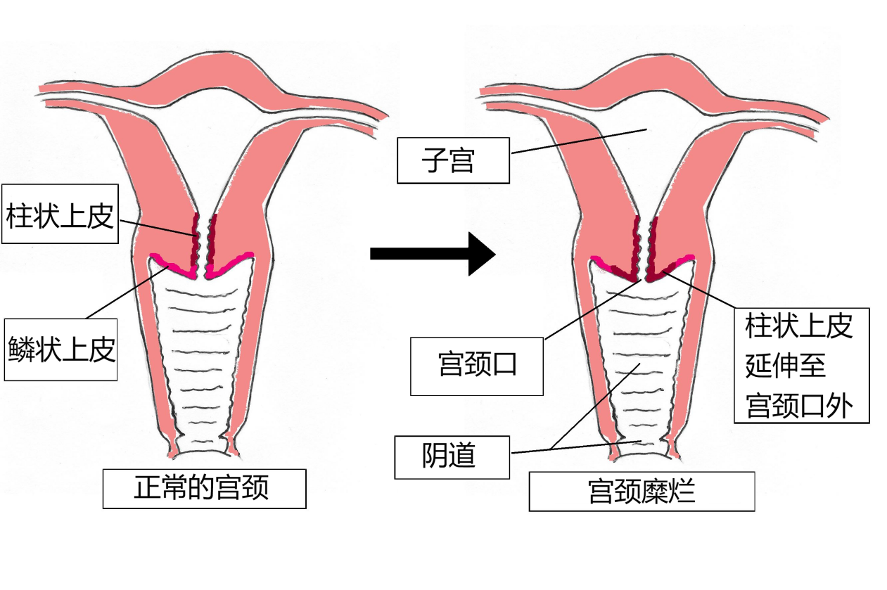 子宫口解剖图片