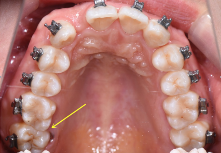 你的牙没缺没烂就是嚼不动有可能是后牙锁合在搞事情