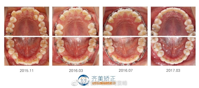 拔牙矫正需要注意这些