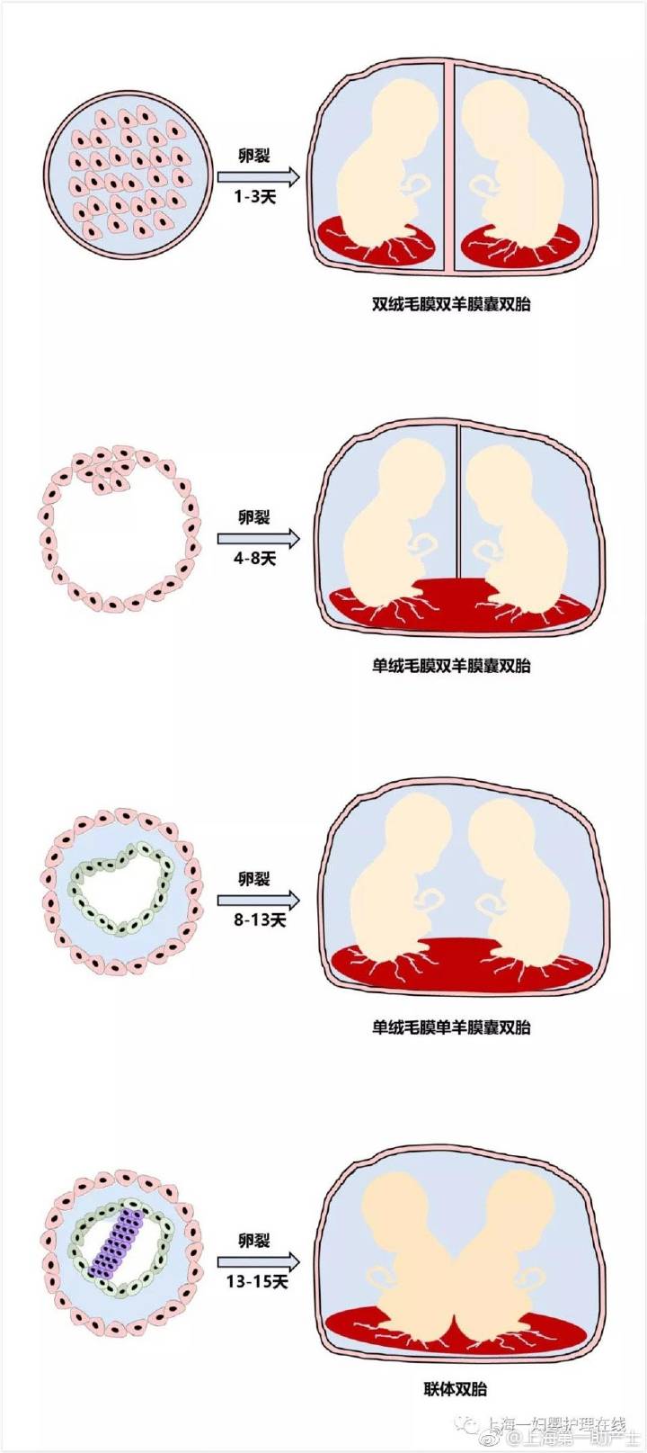 双胎妊娠_刘宏_null_爱问健康