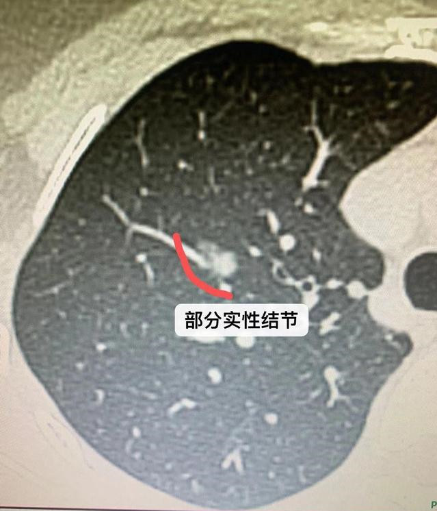 毛玻璃结节图片