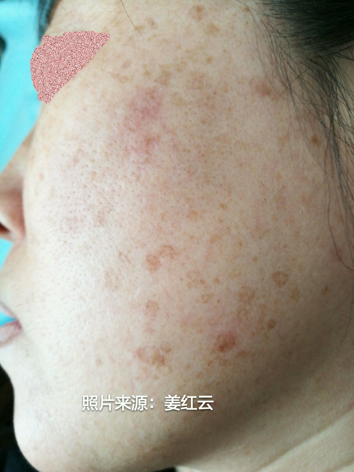 损容性皮肤病汗孔角化症