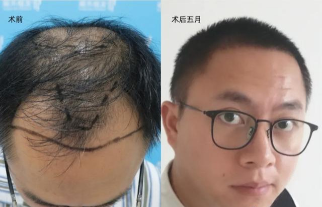 发友严重脱发,要剃光头,被医生劝阻了_刘长春_主任医师_爱问健康