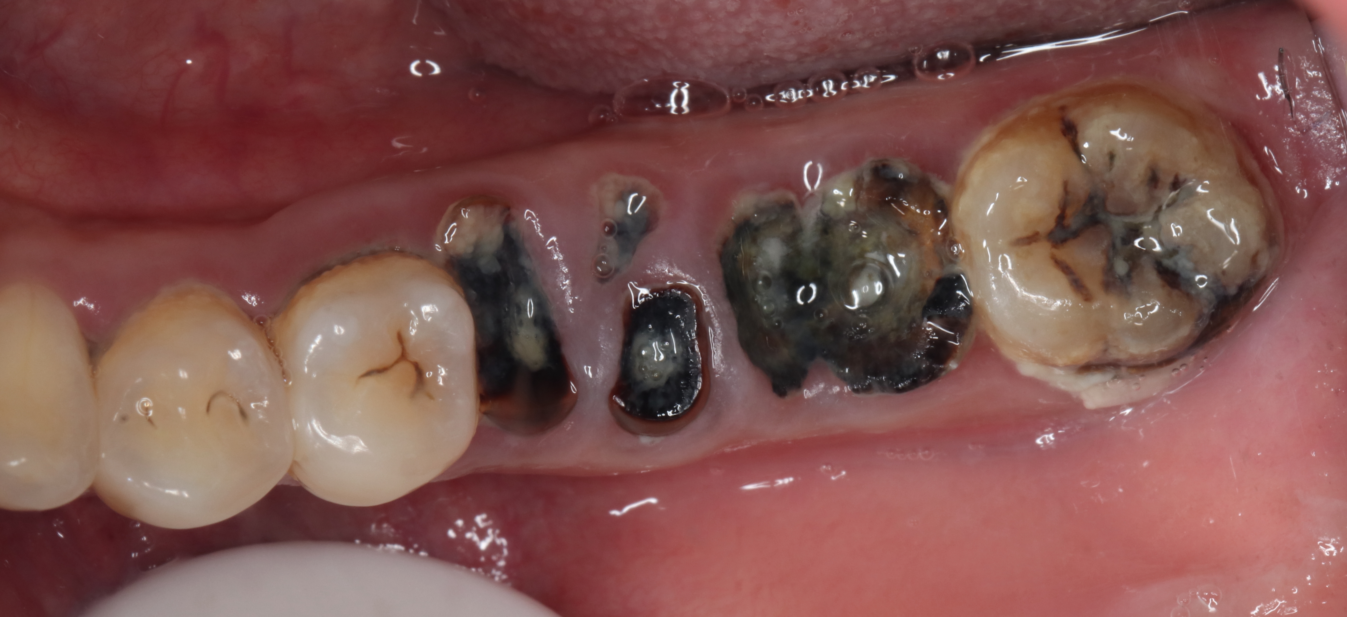 很多时候牙齿开始出问题,没有影响牙神经前可能就有些塞牙症状,表面看