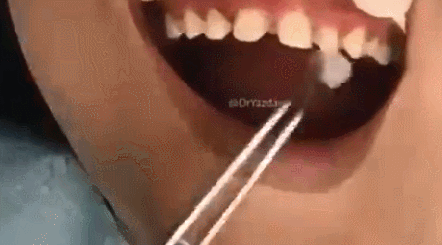 做烤瓷牙全过程，看看牙齿是怎么被磨小的！