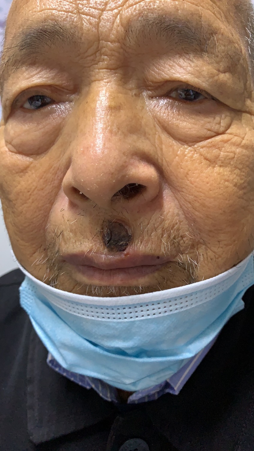 皮肤腺样囊性癌