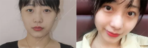 内双可以做成双眼皮吗?_李鹏辉__爱问健康