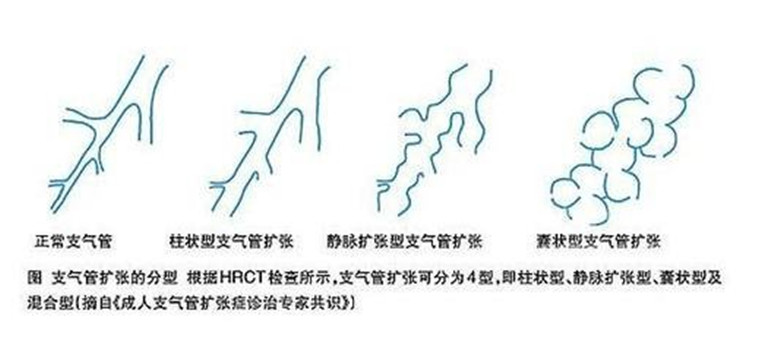 中医对支气管扩张症的认识_张建忠_主任医师_爱问健康