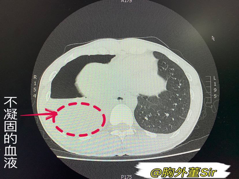 小老弟,这可不好玩。--血气胸_董林_主治医师_爱问健康