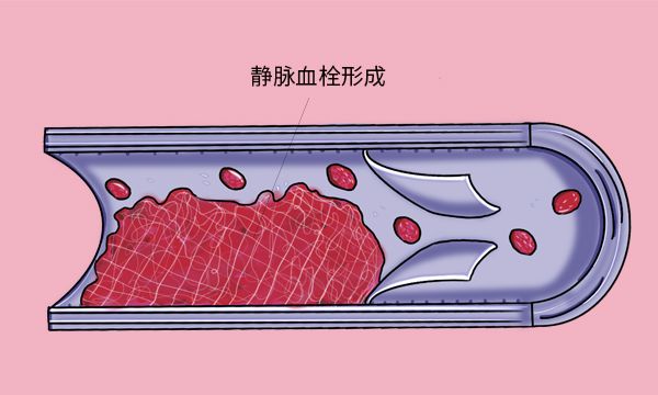 上肢头静脉血栓图片