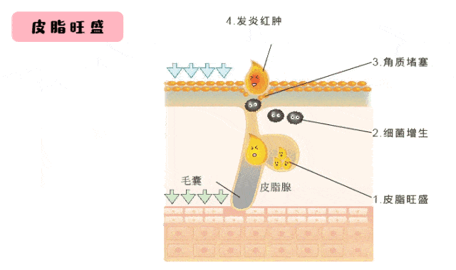 痘痘反复在同一位置生长,是因为“痘根”没有清除,真的吗?_李远宏_主任医师_爱问健康