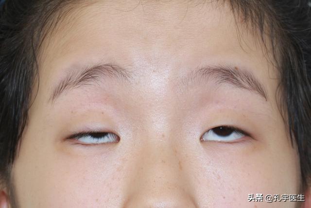 不手术实现小眼变大眼的方法可行吗?