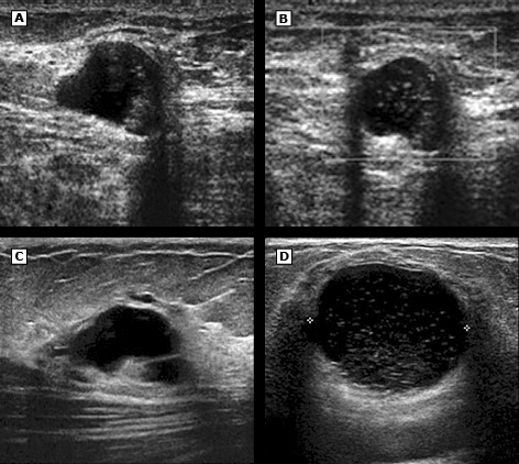 另外,乳腺囊肿也可以根据钼靶或超声对囊肿进行bi-rads评分,用于指导