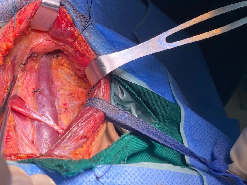 甲状腺癌虽小转移很疯狂