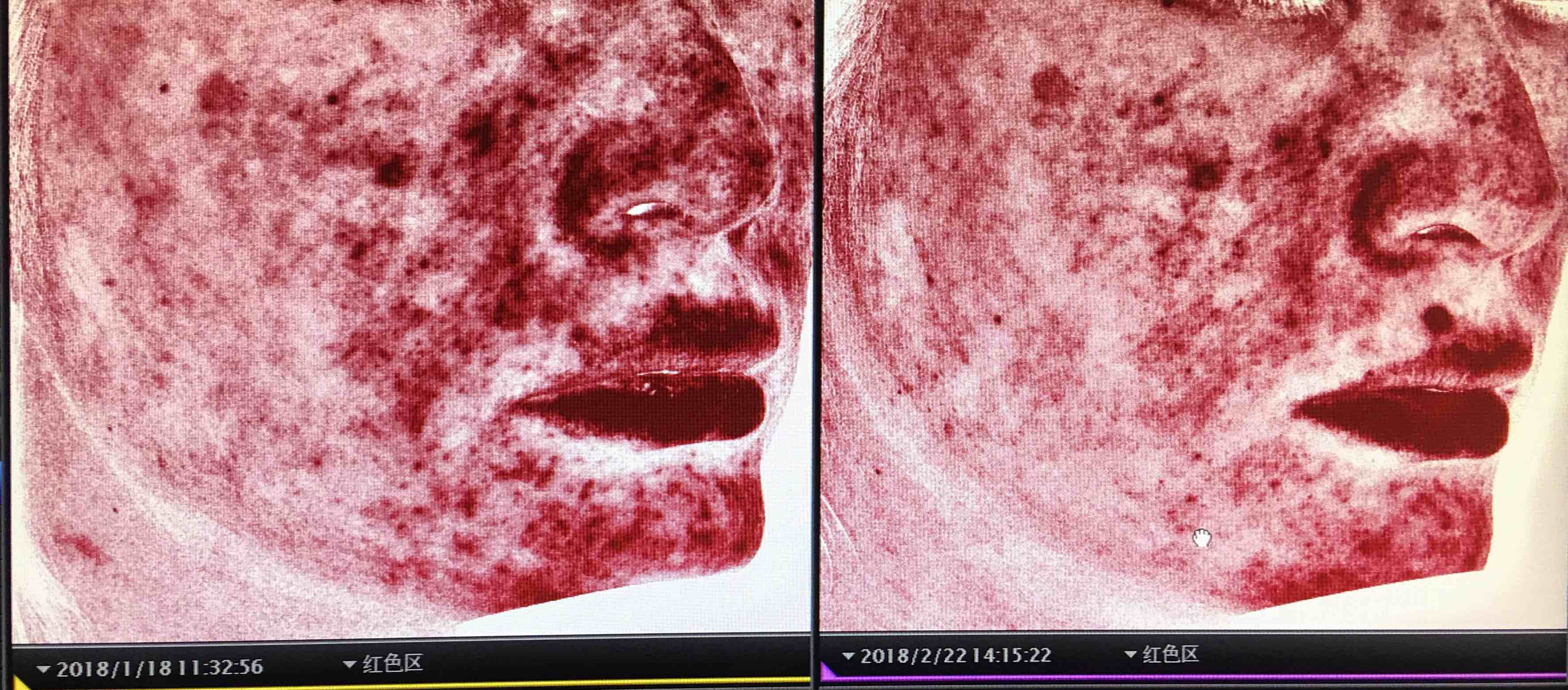 红斑毛细血管扩张型玫瑰痤疮的综合治疗