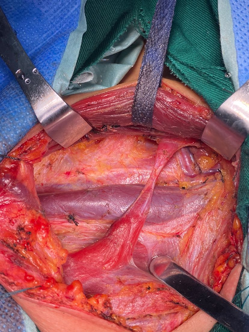 手术方式:甲状腺癌根治(甲状腺双侧全切除) 左颈部2a,3,4,6区淋巴结