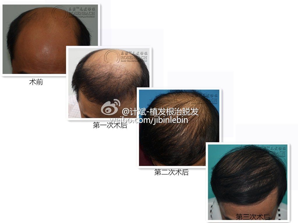 如何客观地对待大面积秃发?_计斌_主治医师_爱问健康