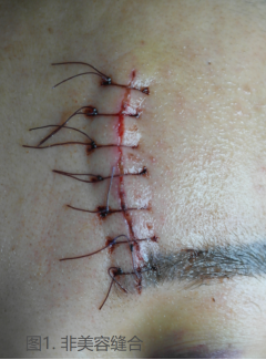 手术缝合针线怎么消毒什么样的缝合才算是美容缝合？_https://www.jmylbn.com_新闻资讯_第1张