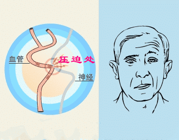 如何诊断面肌痉挛?_于炎冰_主任医师_爱问健康