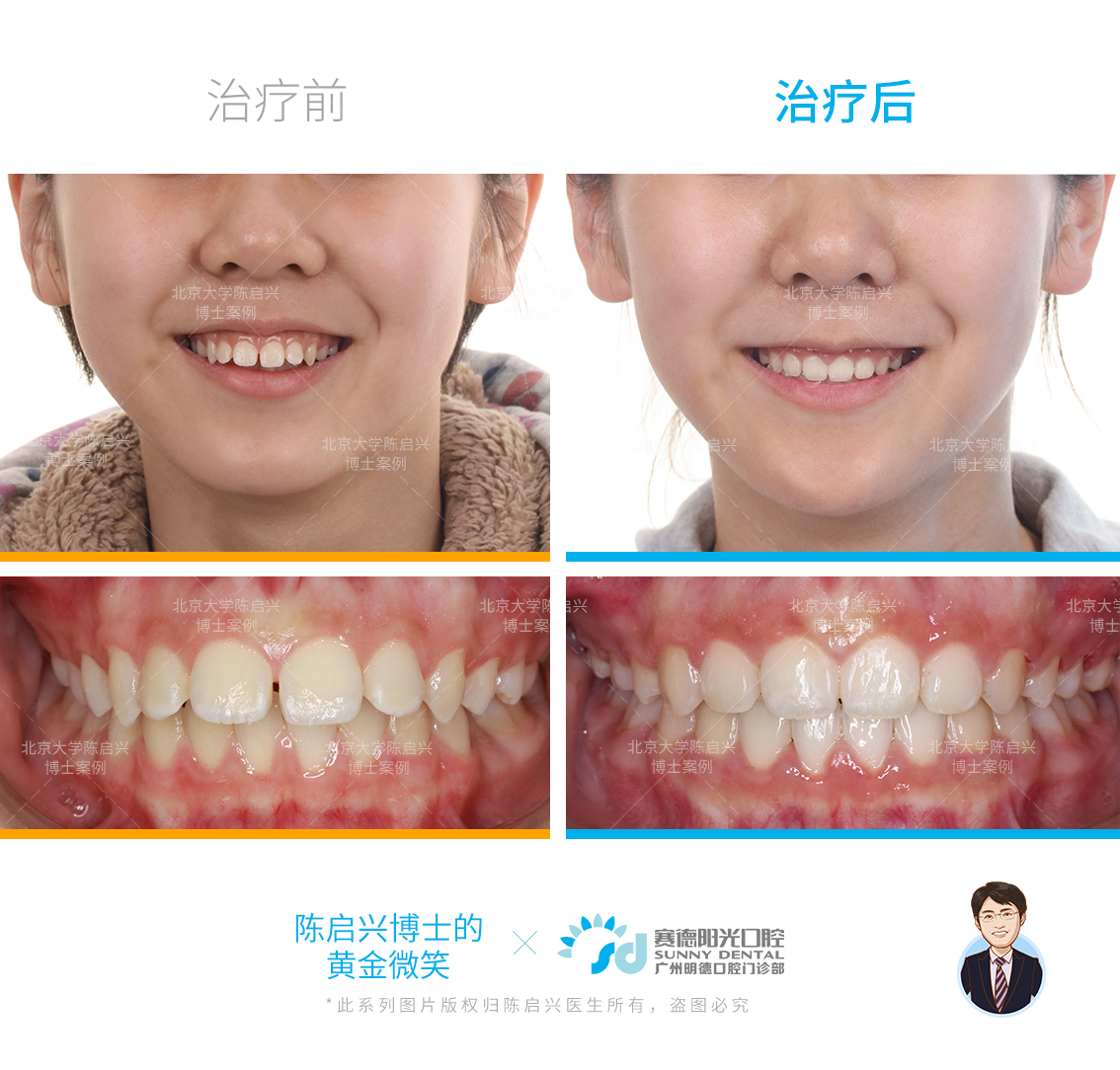 深覆盖+门牙外“飘”+牙缝大矫正案例_陈启兴_副主任医师_爱问健康