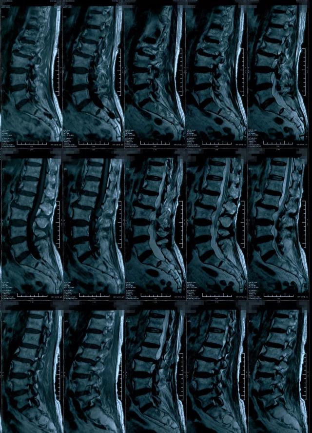 腰椎椎管狭窄ct图片图片