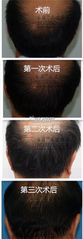 如何客观地对待大面积秃发?_计斌_主治医师_爱问健康