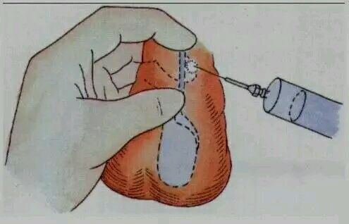 大拇指局部麻醉示意图图片
