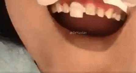 做烤瓷牙全过程，看看牙齿是怎么被磨小的！