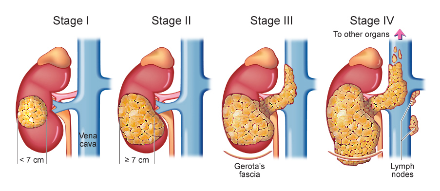 Cell-Carcinoma-sydney-urology-surgeon.jpg