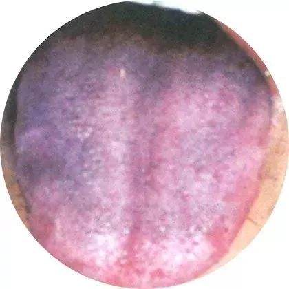 胖大舌、齿痕舌？该如何调理？_胡亮_主治医师_爱问健康