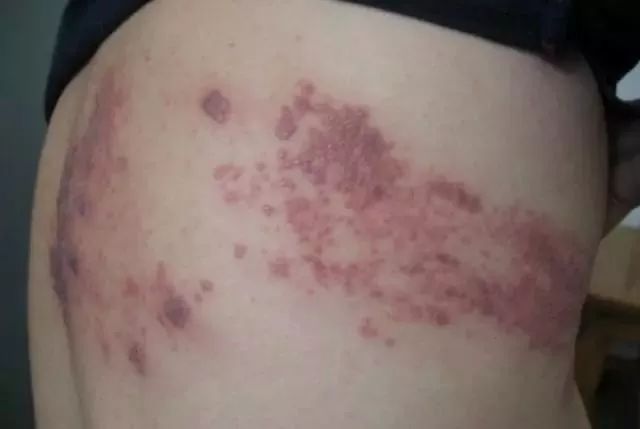 4、带状疱疹有传染性么？ 理论上讲，带状疱疹具有一定的传染性，如果对带状病毒没有免疫力的儿童接触了疱