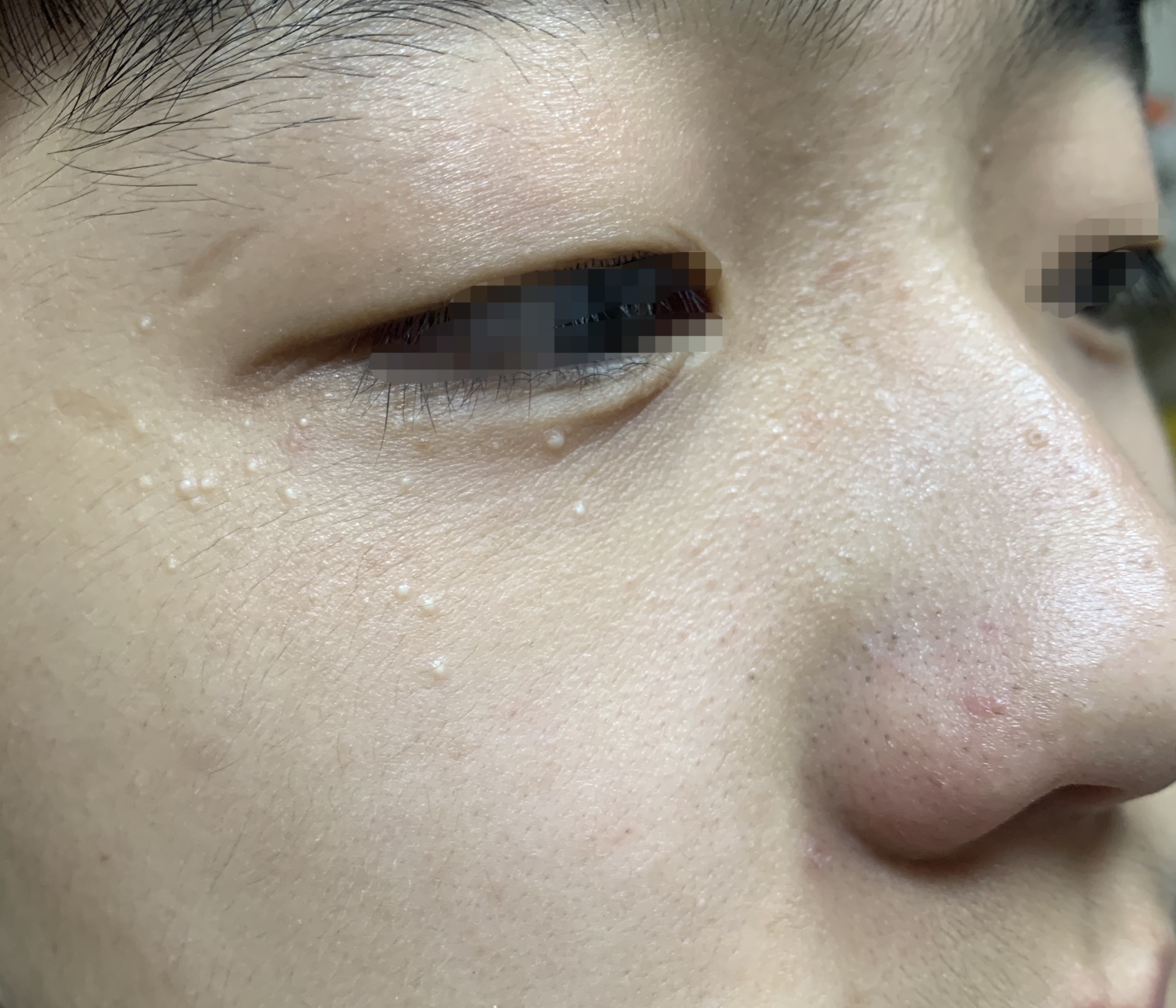 脂肪粒,青春痘,发生在特定年龄吗?_朱敏刚_主任医师_爱问健康