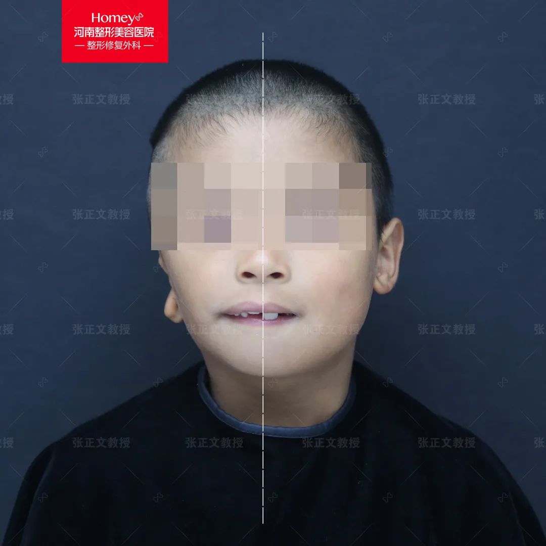 耳畸形伴有的"大小脸",该如何治疗?