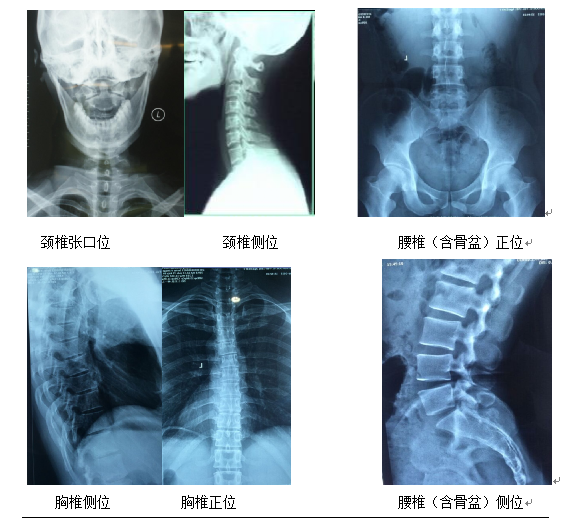 脊骨神经医学简介及标准X光拍片说明_张俊峰_主治医师_爱问健康