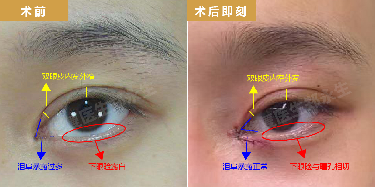毫厘间的睛彩-浅谈内眦赘皮_郑永生_主任医师_爱问健康