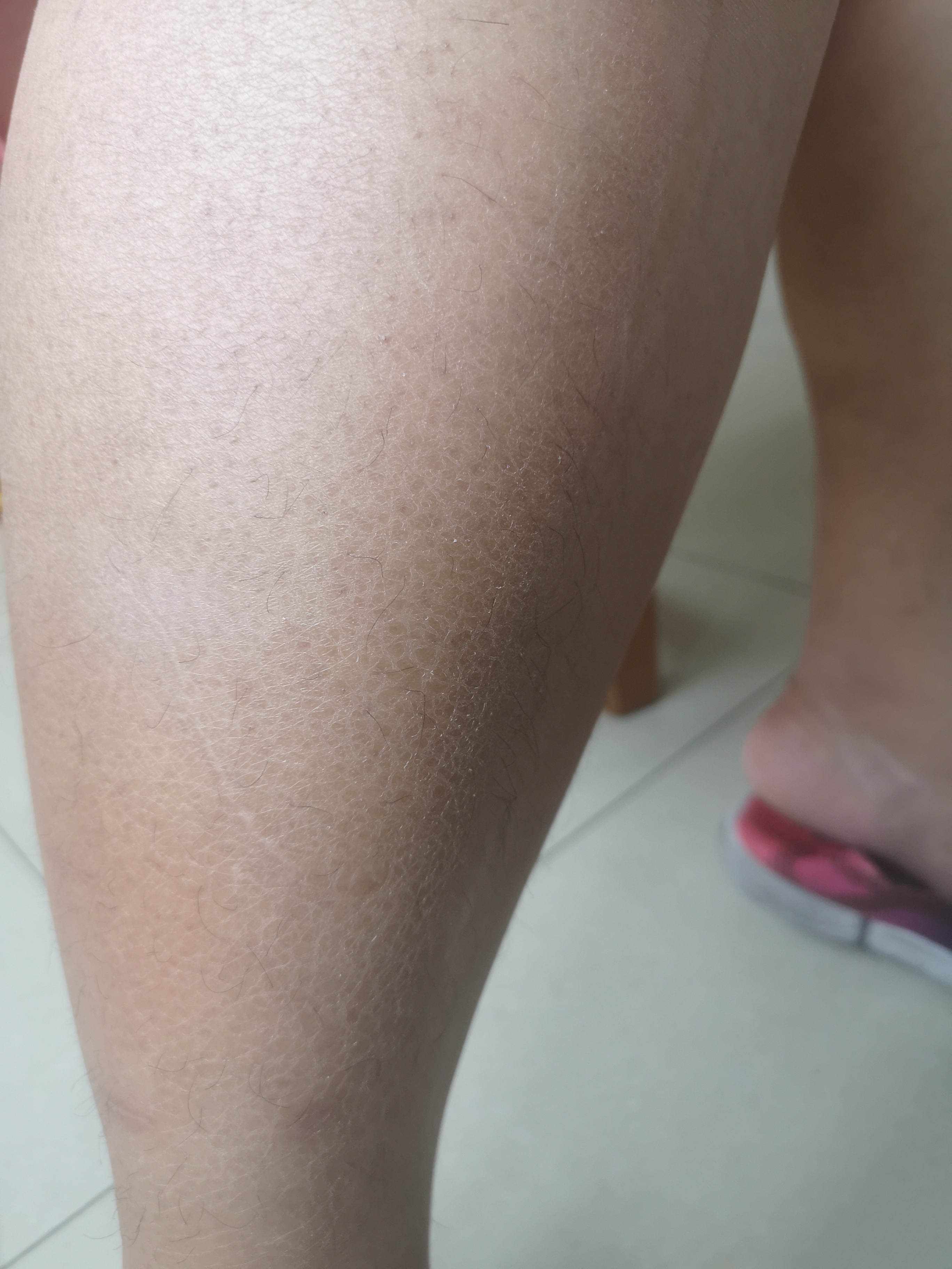 面颊两侧有明显的毛周角化症,也就是民间俗称的鸡皮肤.