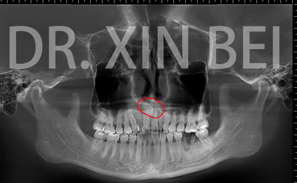 多生牙全景片图片