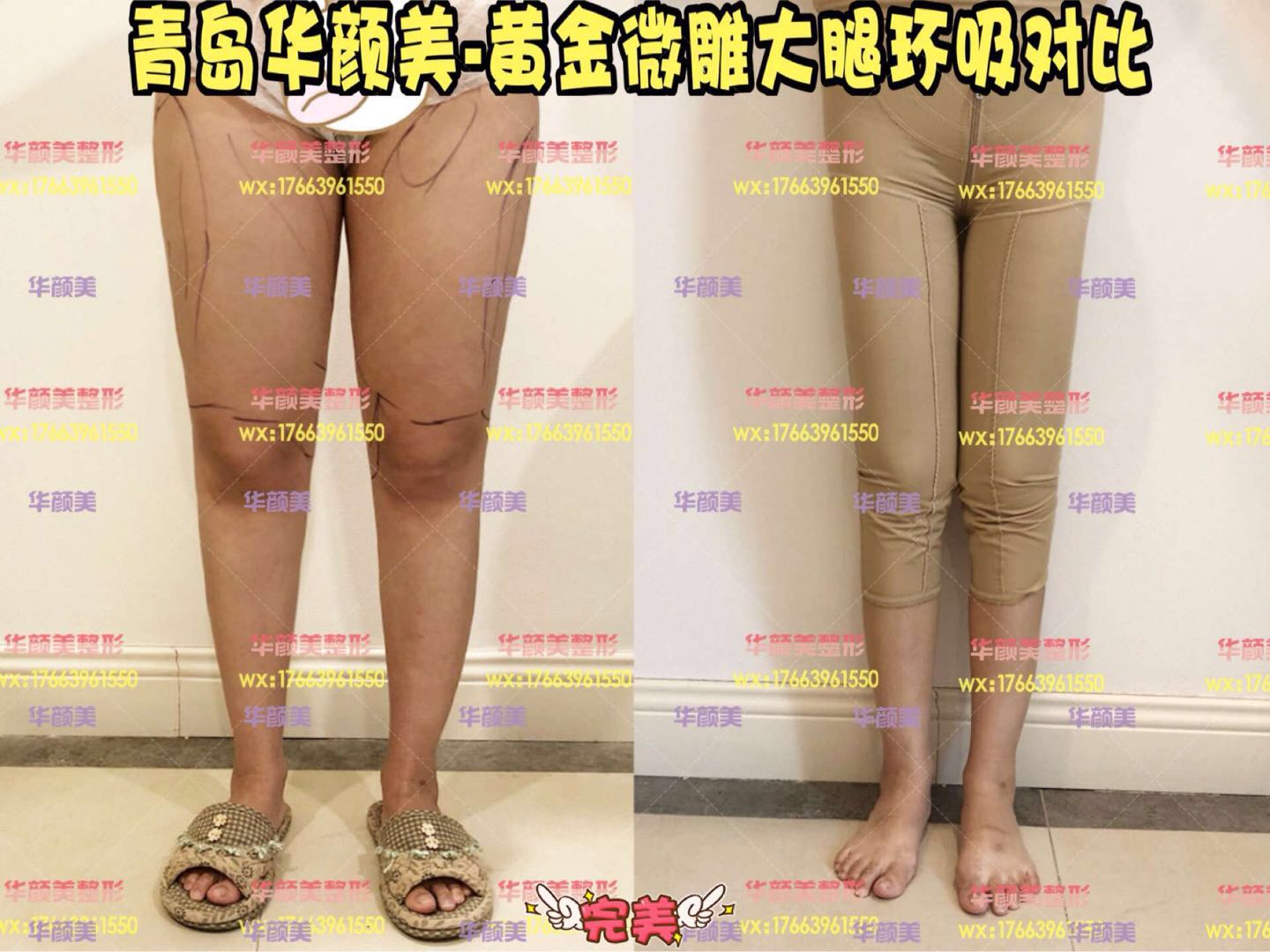 黄金微雕+大腿环吸3.16.jpg