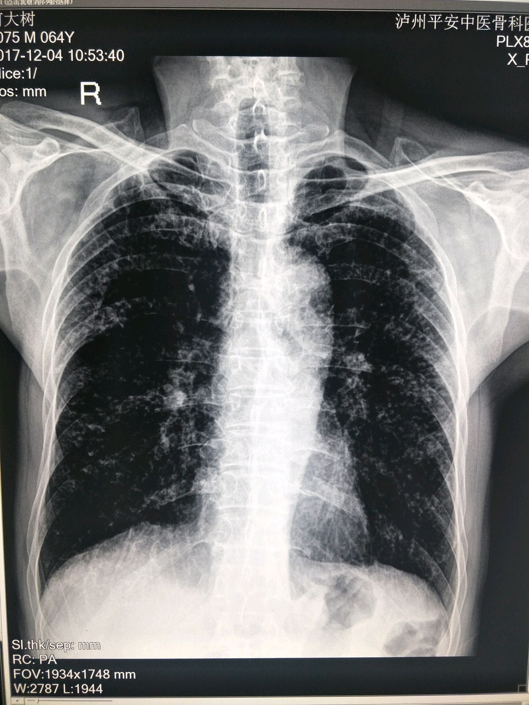 尘肺病ct影象图片图片