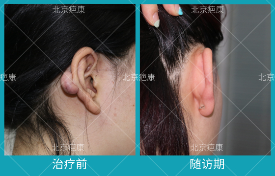 病例分析：重庆陈女士耳廓瘢痕疙瘩