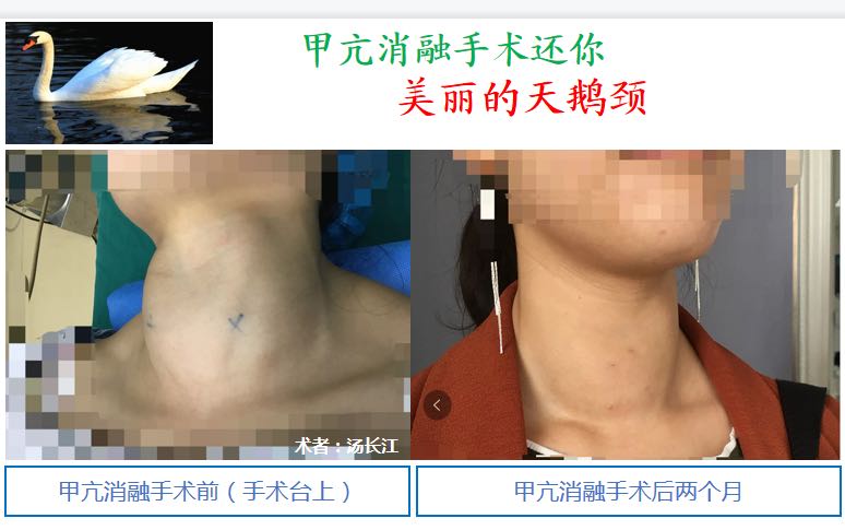 对话年轻女性甲亢患者_汤长江_主任医师_爱问健康