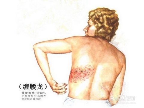 "缠腰龙",你可能关心的10个问题!