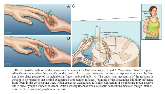 霍夫曼征:该试验使患者处于颈椎中立位,检查者用右手检查患者的右手