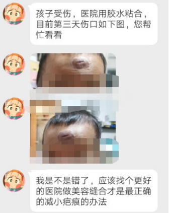 手术缝合针线怎么消毒什么样的缝合才算是美容缝合？_https://www.jmylbn.com_新闻资讯_第4张