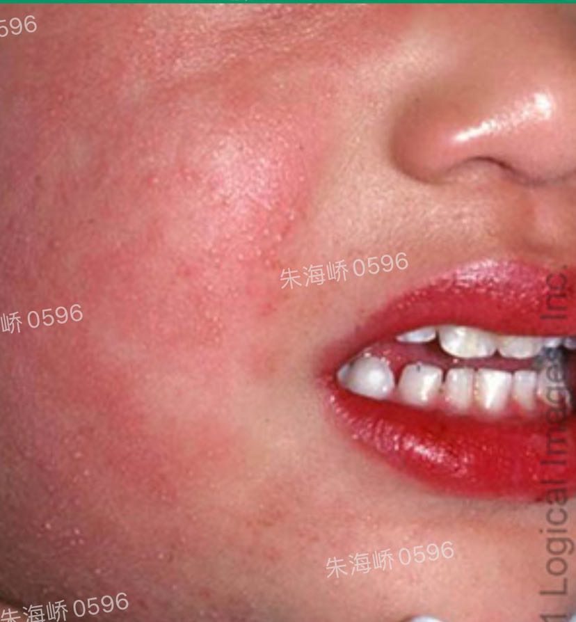 新冠病毒可致川崎病样炎症综合症_朱海峤_主任医师_爱问健康